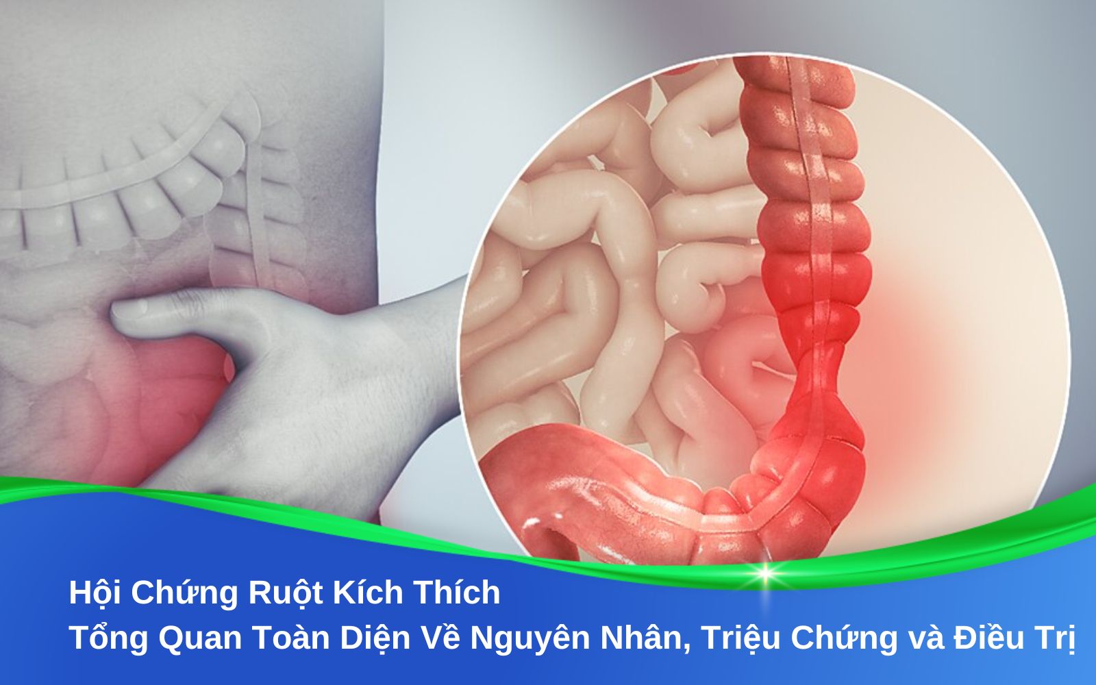 Hội Chứng Ruột Kích Thích Tổng Quan Toàn Diện Về Nguyên Nhân, Triệu Chứng và Điều Trị