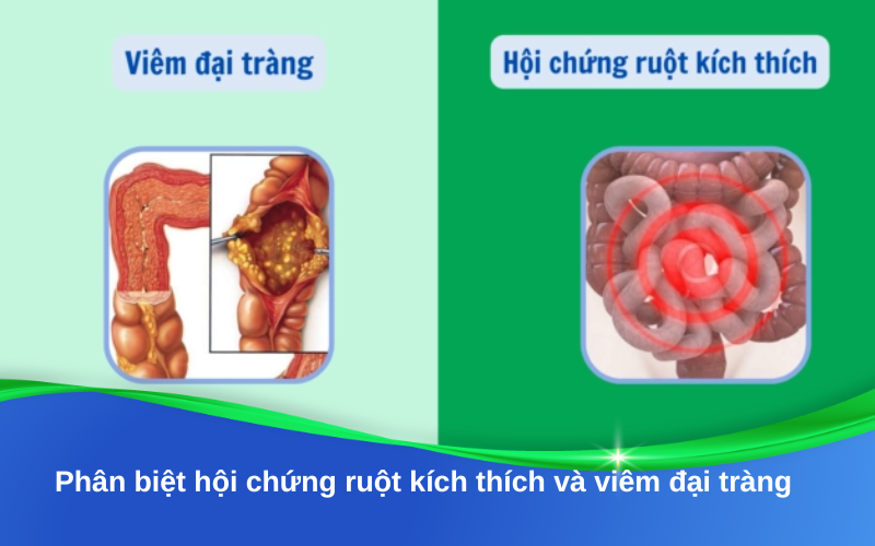 Hội chứng ruột kích thích và viêm đại tràng: Phân biệt đúng để điều trị hiệu quả